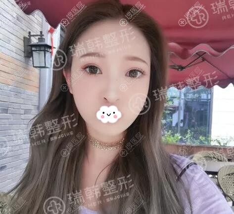 海南瑞韩脂肪填充效果 海南瑞韩脂肪填充效果