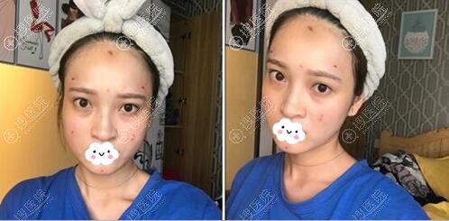 自体脂肪面部填充术后即刻效果 自体脂肪面部填充术后即刻效果