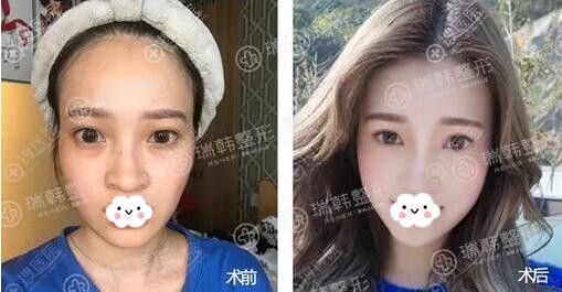 海南瑞韩整形杨永成面部脂肪填充术后对比 海南瑞韩整形杨永成面部脂肪填充术后对比