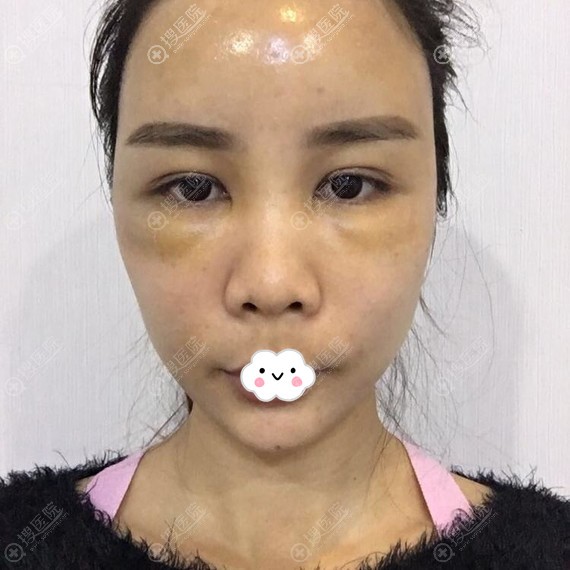 成都悦好裴柄万自体脂肪填充全脸术后10天效果 成都悦好裴柄万自体脂肪填充全脸术后10天效果