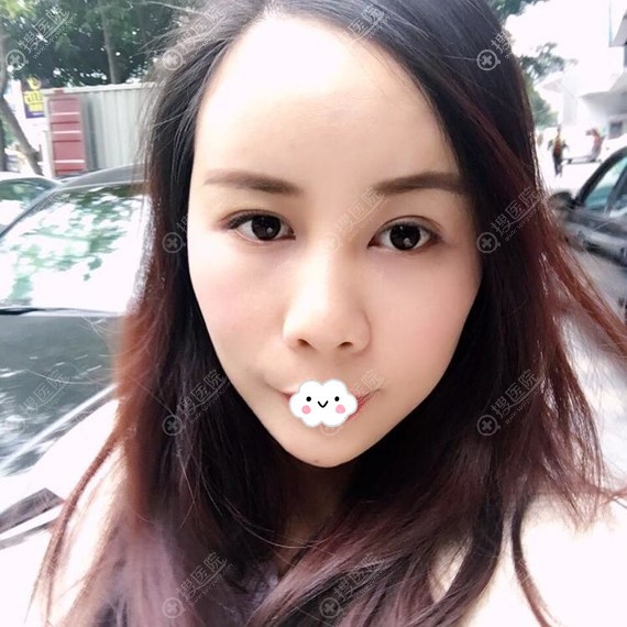 四川自体脂肪面部填充哪家好?成都悦好裴柄万案例 四川自体脂肪面部填充哪家好?成都悦好裴柄万案例