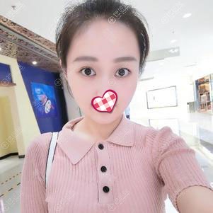 常州美贝尔自体脂肪填充面部2个月效果图 常州美贝尔自体脂肪填充面部2个月效果图