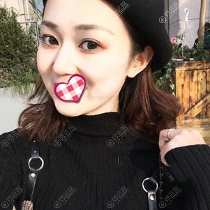 常州美贝尔面部自体脂肪填充3个月恢复图 常州美贝尔面部自体脂肪填充3个月恢复图