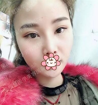 海南兰颜慧双眼皮术后恢复效果 海南兰颜慧双眼皮术后恢复效果