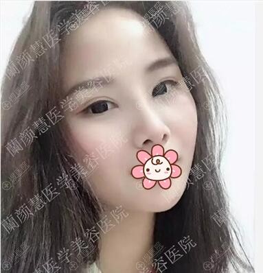 双眼皮开眼角术后效果展示 双眼皮开眼角术后效果展示