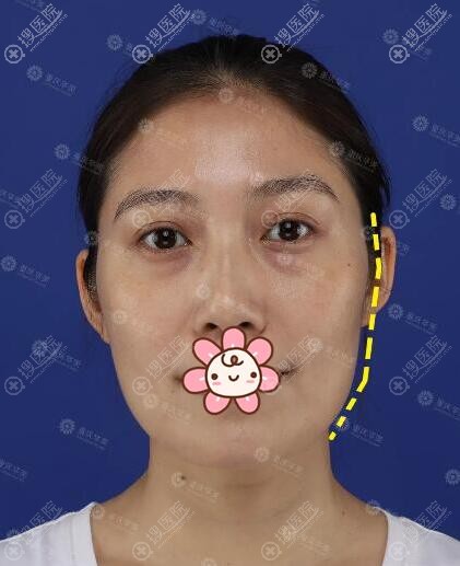 太狠了 她在重庆华美做抽脂面部脂肪填充只为素颜美如少女