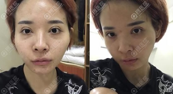 想要的童颜效果通过在石家庄雅芳亚抽脂和自体脂肪填充实现了