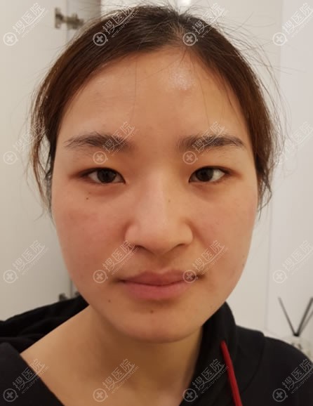 韩国纯真医院隆鼻和双眼皮手术是这么做的,崔宰源院长技术真棒