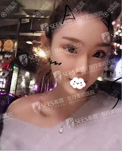 我就是看了深圳希思整形医院李俊综合鼻整形案例,才决定去隆鼻
