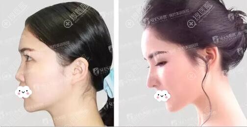 李俊综合隆鼻术前术后对比 李俊综合隆鼻术前术后对比