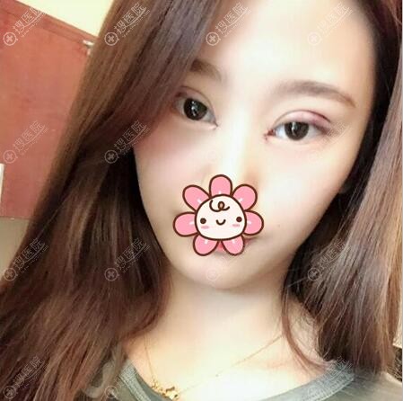˫��Ƥ���۽�����3����Ƭ