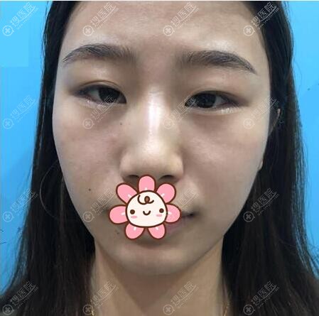 ���۾�ǰ��������Ƭ