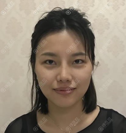 鼓足勇气再次躺上手术台,找合肥壹美尚叶冠青做失败双眼皮修复