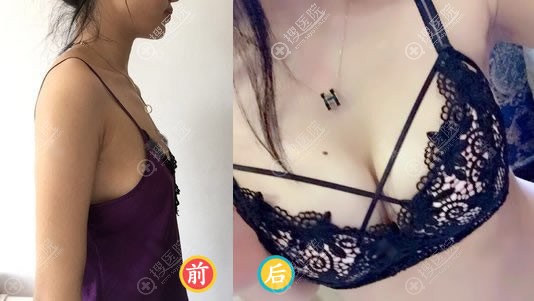 泉州脂管加俞富兴自体脂肪隆胸案例 泉州脂管加俞富兴自体脂肪隆胸案例