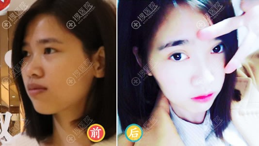 泉州脂管加杨杰双眼皮和开眼角案例 泉州脂管加杨杰双眼皮和开眼角案例