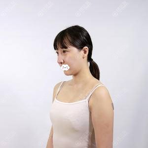 这是广州曙光医学美容医院万友望做CGF自体脂肪隆胸案例与价格