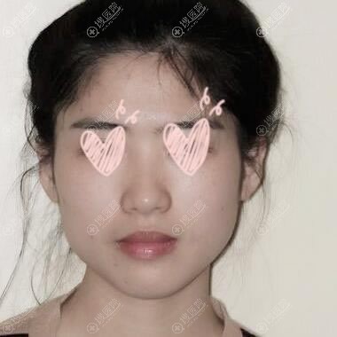 受够了突出的下颌角,花4万找兰州仁和医院张爽主任把下颌骨切了