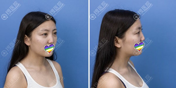 赣州韩美鼻综合术前照片 赣州韩美鼻综合术前照片