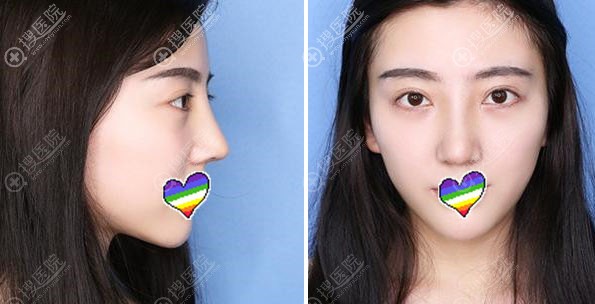 拆线后鼻综合术后10天效果图 拆线后鼻综合术后10天效果图