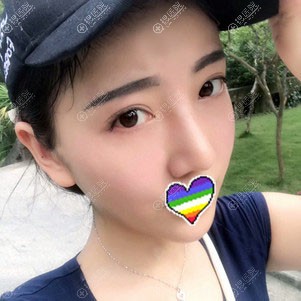 赣州韩美鼻综合手术恢复2个月案例图 赣州韩美鼻综合手术恢复2个月案例图