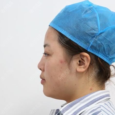 北京东方和谐整形医院吸脂谁做得好?王自谦下巴吸脂案例在此
