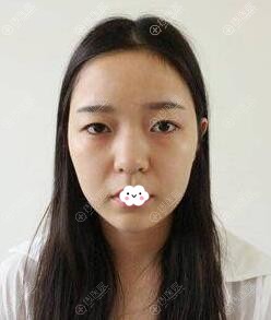 <!--<i data=20240710 data-id=15150></i>-->钟正强双眼皮+假体隆鼻真人案例 <!--<i data=20240710 data-id=15150></i>-->钟正强双眼皮+假体隆鼻真人案例