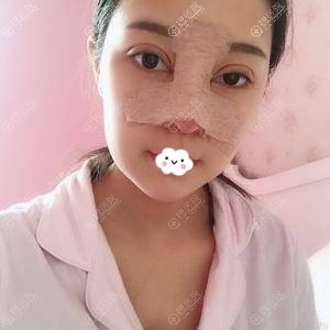 <!--<i data=20240710 data-id=15150></i>-->钟正强双眼皮+假体隆鼻术后效果 <!--<i data=20240710 data-id=15150></i>-->钟正强双眼皮+假体隆鼻术后效果