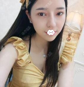 <!--<i data=20240710 data-id=15150></i>-->双眼皮+鼻综合效果怎么样?钟正强案例 <!--<i data=20240710 data-id=15150></i>-->双眼皮+鼻综合效果怎么样?钟正强案例