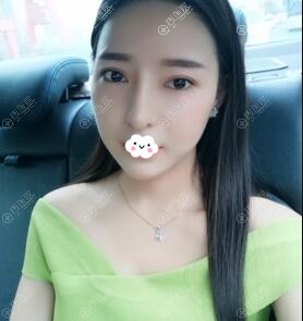 <!--<i data=20240710 data-id=15150></i>-->割双眼皮+鼻综合术后3个月案例恢复效果 <!--<i data=20240710 data-id=15150></i>-->割双眼皮+鼻综合术后3个月案例恢复效果