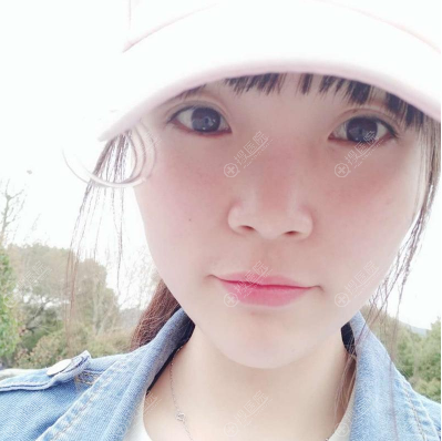 都说西安高一生医院隆鼻做的好,去找刘军做完鼻综合果然很满意