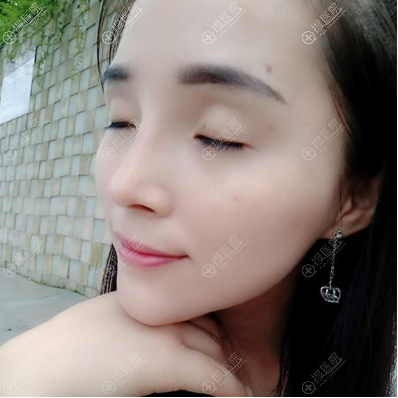 西安高一生隆鼻案例术后效果图 西安高一生隆鼻案例术后效果图