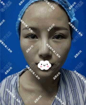 本来想做面部脂肪填充经深圳南雅万芸医师建议后我又割了双眼皮