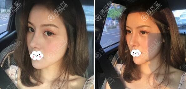 达拉斯鼻综合+丰下巴手术12天恢复照 达拉斯鼻综合+丰下巴手术12天恢复照