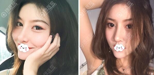 龙鹏辉半肋鼻综合+假体垫下巴术后4个月 龙鹏辉半肋鼻综合+假体垫下巴术后4个月