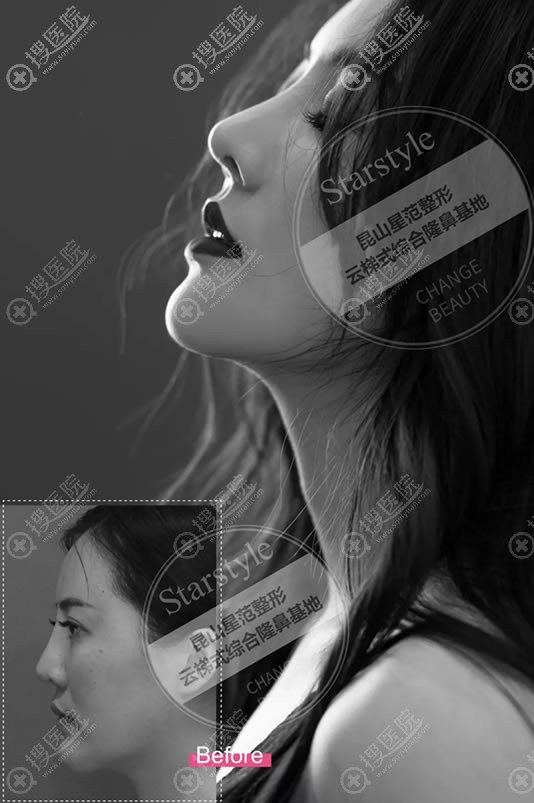 昆山星范张多辉鼻综合隆鼻案例 昆山星范张多辉鼻综合隆鼻案例