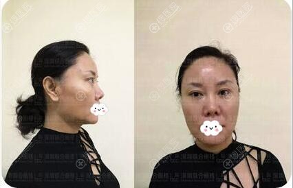 深圳联合丽格整形陈银东美国强生鱼骨线线雕15天前后对比效果图