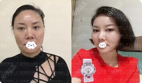 <!--<i data=20240710 data-id=12014></i>-->陈银东美国强生鱼骨线雕术后15天对比 <!--<i data=20240710 data-id=12014></i>-->陈银东美国强生鱼骨线雕术后15天对比