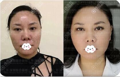 陈银东强身鱼骨线线雕术后一天效果对比图 陈银东强身鱼骨线线雕术后一天效果对比图