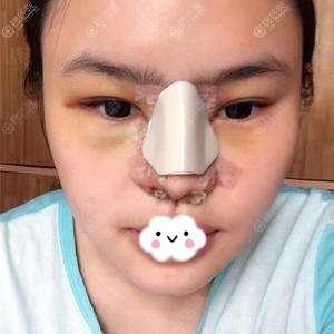 成都美容整形医院硅胶隆鼻+假体垫下巴术后效果图 成都美容整形医院硅胶隆鼻+假体垫下巴术后效果图