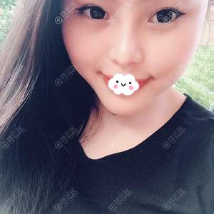 成都美容整形隆鼻+下巴整形真实案例恢复图 成都美容整形隆鼻+下巴整形真实案例恢复图