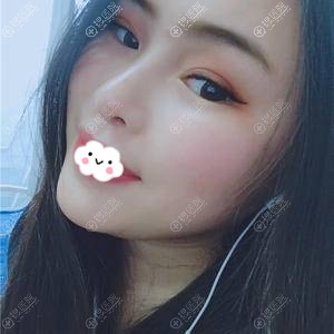 成都成美美容整形医院假体隆鼻+垫下巴术后3个月效果 成都成美美容整形医院假体隆鼻+垫下巴术后3个月效果