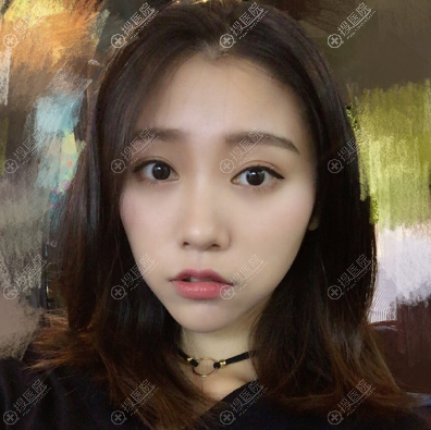 重庆yestar艺星做双眼皮怎么样 重庆yestar艺星做双眼皮怎么样
