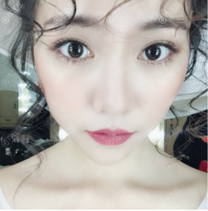 重庆yestar艺星美杜莎综合美眼双眼皮案例 重庆yestar艺星美杜莎综合美眼双眼皮案例