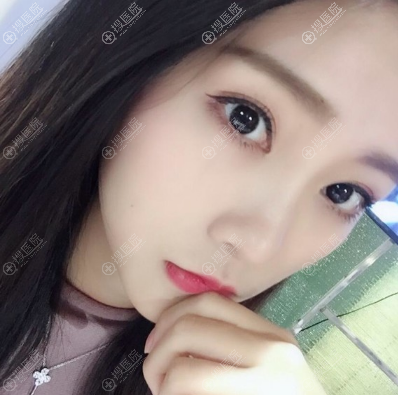重庆yestar王医生双眼皮案例 重庆yestar王医生双眼皮案例
