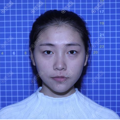 重庆艺星双眼皮案例术前照片 重庆艺星双眼皮案例术前照片