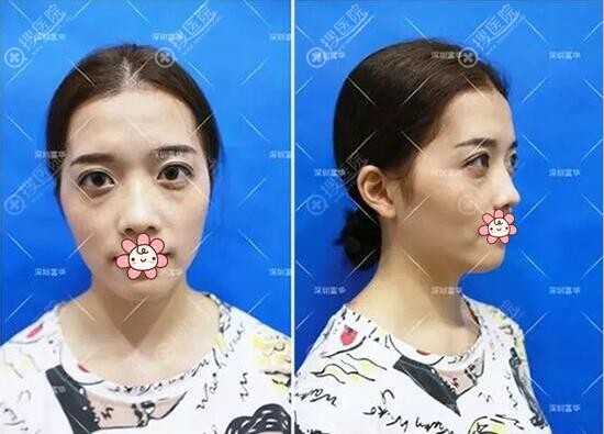 深圳富华曹孟君自体脂肪面部填充手术全记录附术后3个月恢复照