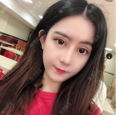 合肥壹美尚隆鼻案例术后照片 合肥壹美尚隆鼻案例术后照片