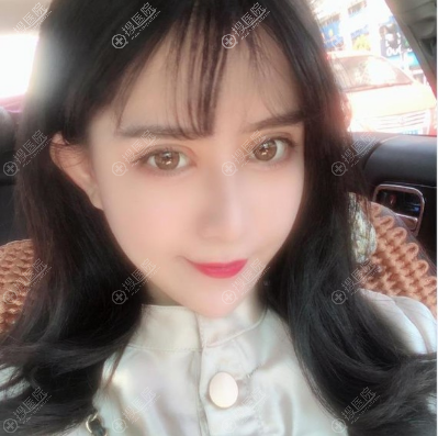 合肥壹美尚<!--<i data=20240710 data-id=16586></i>-->医生双眼皮隆鼻案例 合肥壹美尚<!--<i data=20240710 data-id=16586></i>-->医生双眼皮隆鼻案例