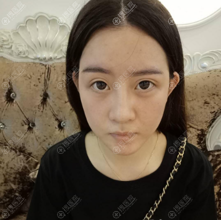 很庆幸我的双眼皮隆鼻是找合肥壹美尚原合肥丽人叶冠青医生做的