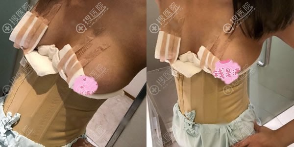刚做完腰腹抽脂和脂肪隆胸图片 刚做完腰腹抽脂和脂肪隆胸图片